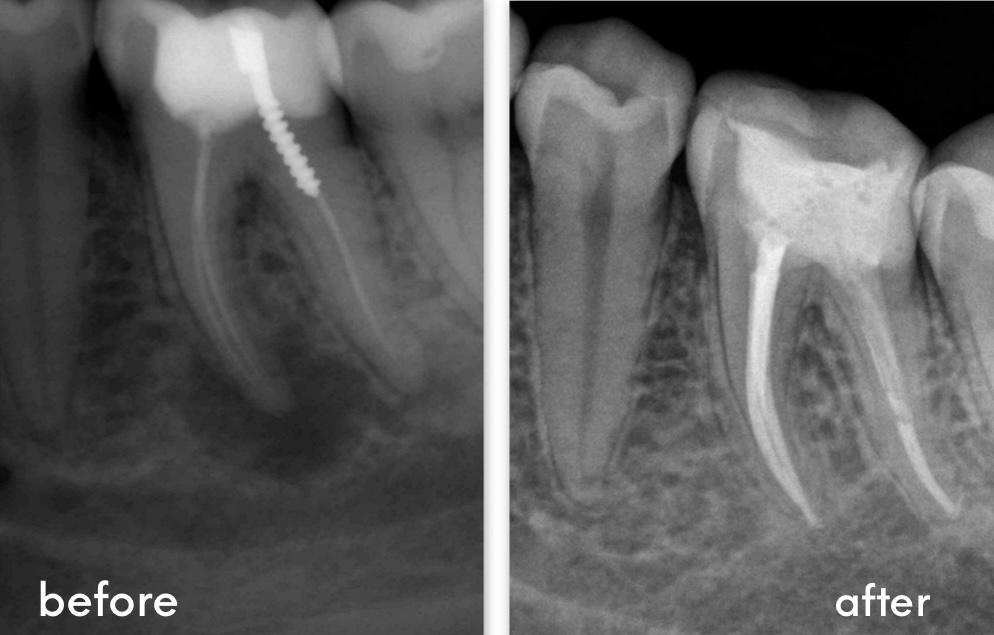 Complex Endodontic Procedures